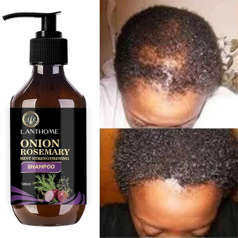 Hair Shampoo For Fast Hair Growth Rosemary Onion Hair Regrowth Shampoo Anti Hair Loss Effective Within 7 Day Hair Growth Product